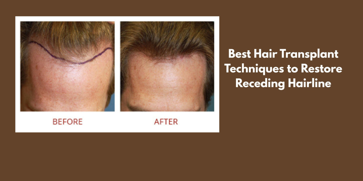 Best Hair Transplant Techniques to Restore Receding Hairline