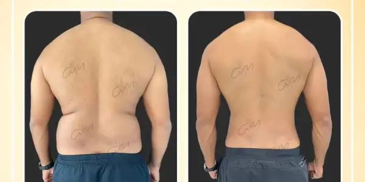 Sculpt Your Ideal Body: Liposuction in Dubai with Dr. Hans Plastic Surgeon