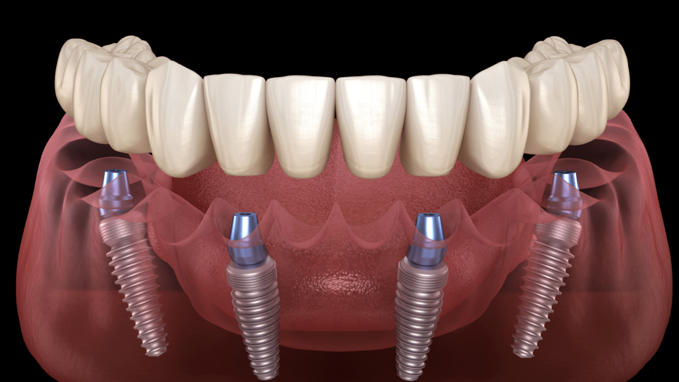 All-On-4 Dental Implants: Benefits, Procedure, and Cost