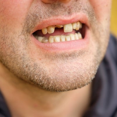 Teeth Fracture Treatment in Islamabad, Rawalpindi, and Pakistan