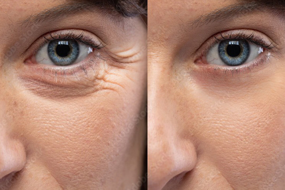 Why More People in Enschede Are Choosing Botox for a Fresh Look in 2026 - JustPaste.it