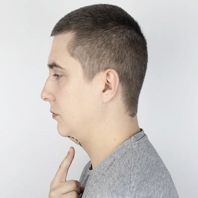 Double Chin Liposuction in Islamabad Pakistan | RCS