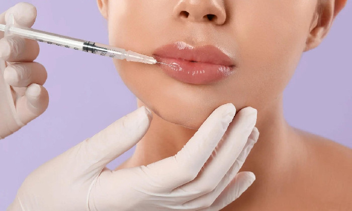 Lipfillertrends in 2026: worden vollere lippen vervangen door baby filler? :: Health