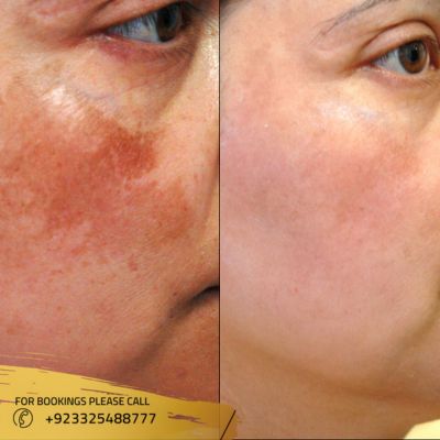 Skin Pigmentation Treatment in Islamabad, Pakistan | Cost