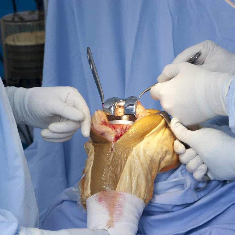 Knee Replacement Surgery in Bangalore | DHEE Hospitals