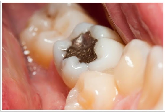 Understanding Cavities and Composite Fillings