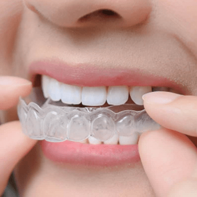 Best Teeth Aligners in Islamabad, Pakistan
