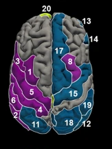 Top view of a standard cortical surface of the human brain, with the front of the brain at the top and the back of the brain at the bottom of the picture.  The left hemisphere pre- and post-central gyrus and parietal cortex are highlighted in purple, indicating regions where the individuals with schizophrenia showed thinner cortex than healthy controls; on the right hemisphere are many blue areas, indicating regions where the individuals with deficit schizophrenia showed thinner cortices, but non-deficit schizophrenia subjects did not.