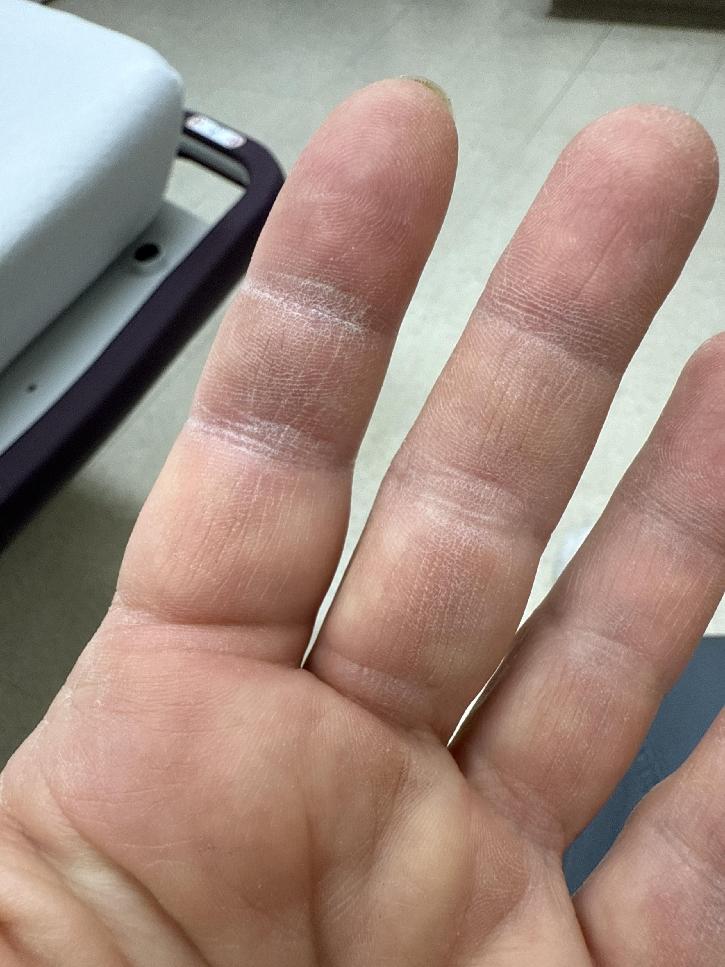 Photograph of my left hand that includes the problem finger. It doesn't look bad in the photo, but it's definitely swollen and looks a little bruised. The pain is mostly in my knuckle area now.