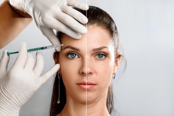 Una mujer joven mostrando el efecto de las inyecciones de bótox. (Getty Images)