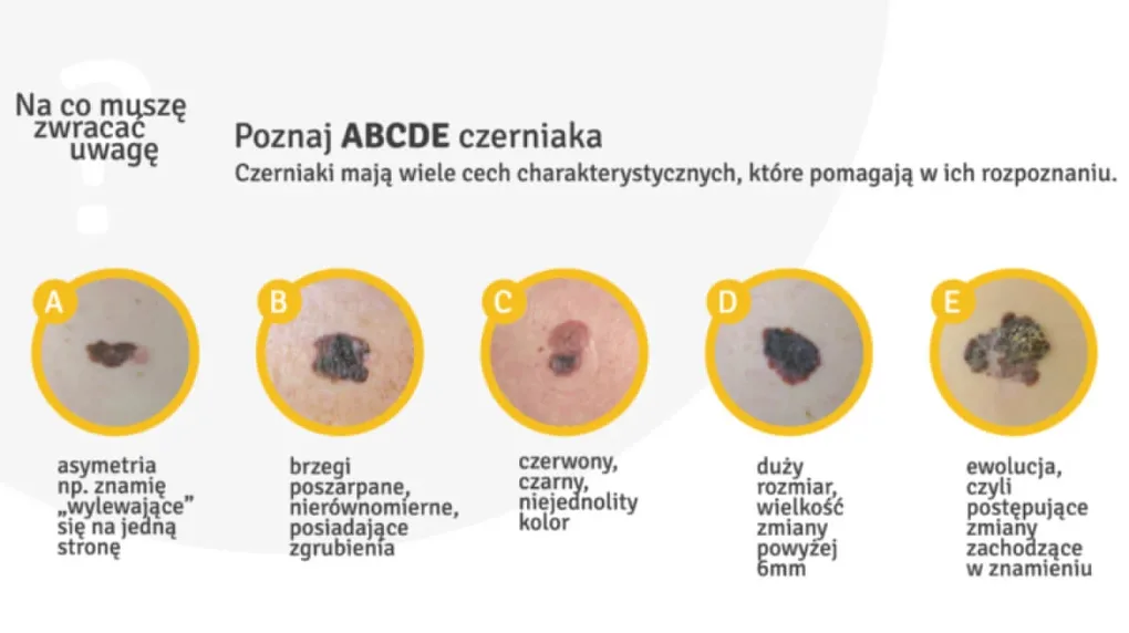 Masz znamię? To może być czerniak. Tydzień Świadomości Czerniaka