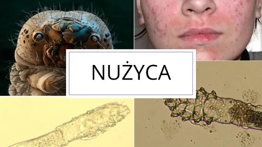 Nużyca - przeczytaj, co warto o niej wiedzieć